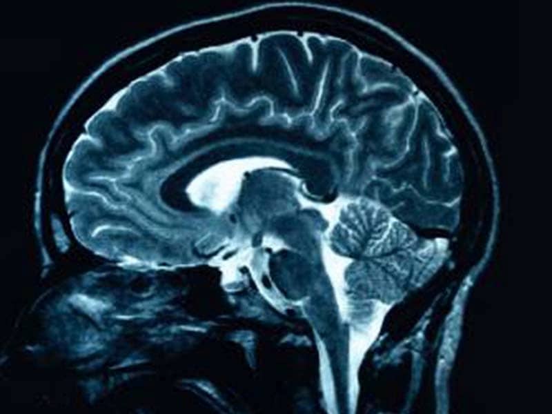 Brain MRI Scan - Echelon Health Blog