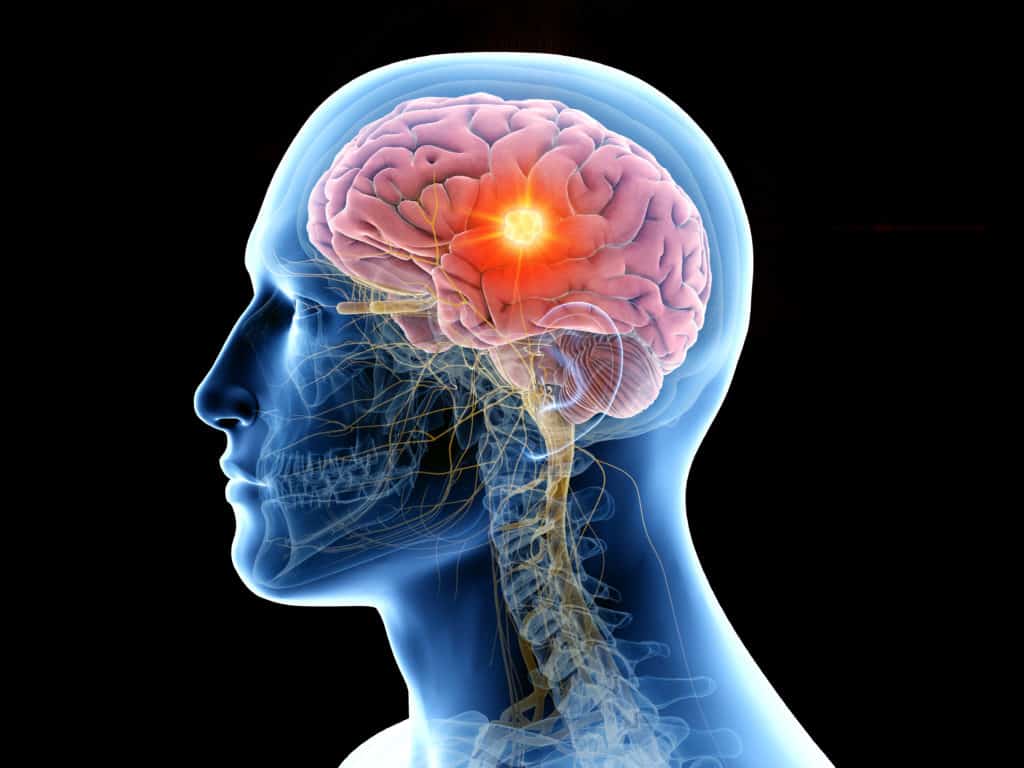 brain tumour diagnosis and symptoms - Echelon Health